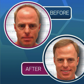 Resultados de trasplante capilar antes y después en Proesthe Hair Transplant Center, línea restaurada