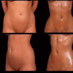 Liposuction Before & After Photos in Estetik International