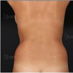 Liposuction Before & After Photos in Estetik International