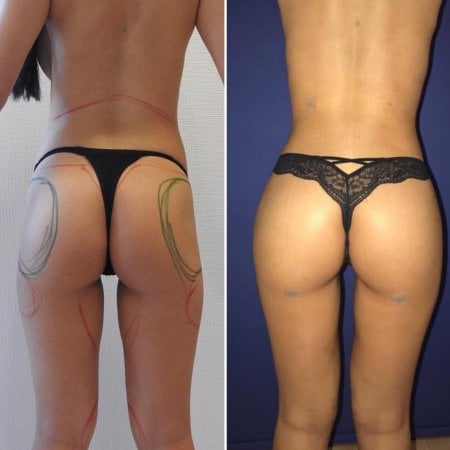 نتائج قبل وبعد عملية شد المؤخرة البرازيلية في مركز إسطنبول للجراحة التجميلية