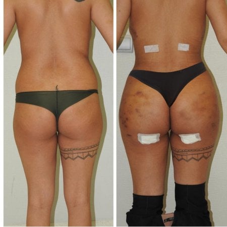 Before and after Brazilian Butt Lift results at Istanbul Aesthetic Plastic Surgery Center