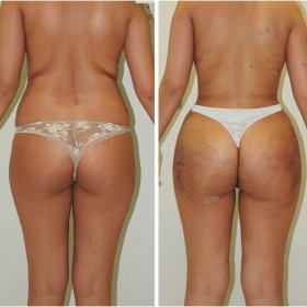 Brazilian Butt lift Before & After Photos in Istanbul Aesthetic Plastic Surgery Center
