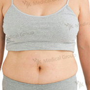 Tummy tuck Before & After Photos in JK Plastic Surgery Center