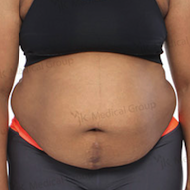 Результати абдомінопластики до і після в JK Plastic Surgery Center – покращений контур живота