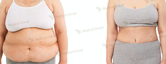 Результаты абдоминопластики до и после в JK Plastic Surgery Center, видимое моделирование живота