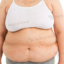 Результати абдомінопластики до і після в JK Plastic Surgery Center, помітний контур живота