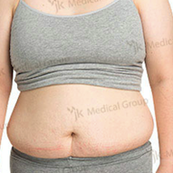 Tummy tuck Before & After Photos in JK Plastic Surgery Center