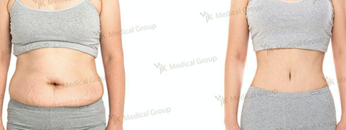 Результаты абдоминопластики до и после в JK Plastic Surgery Center – подтянутый живот