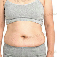 Tummy tuck Before & After Photos in JK Plastic Surgery Center