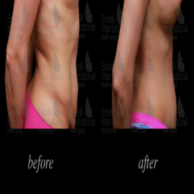 Tummy tuck Before & After Photos in Estetik International
