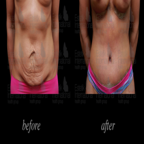 Tummy tuck Before & After Photos in Estetik International
