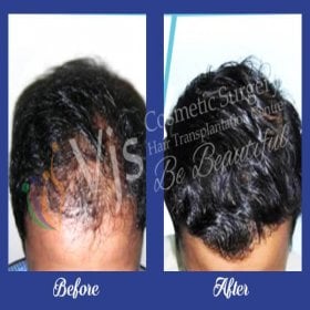 Resultados de trasplante capilar antes y después en Dr. VJs Cosmetic Surgery Clinic, mayor densidad