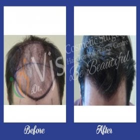 Resultados de trasplante capilar antes y después en Dr. VJs Cosmetic Surgery Clinic, línea restaurada