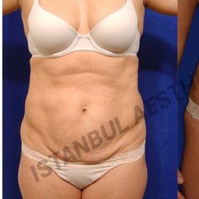 Tummy tuck Before & After Photos in Istanbul Aesthetic Plastic Surgery Center