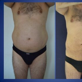 Tummy tuck Before & After Photos in Istanbul Aesthetic Plastic Surgery Center