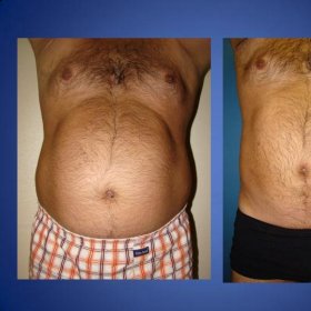 Tummy tuck Before & After Photos in Istanbul Aesthetic Plastic Surgery Center