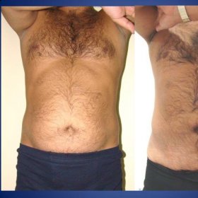Tummy tuck Before & After Photos in Istanbul Aesthetic Plastic Surgery Center