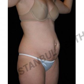 Tummy tuck Before & After Photos in Istanbul Aesthetic Plastic Surgery Center