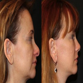 Resultados de rinoplastia antes y después en la Academia Ucraniana de Cirugía Plástica, remodelación nasal