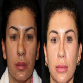 Resultados de rinoplastia antes y después en Ukrainian Academy of Plastic Surgery, remodelación nasal