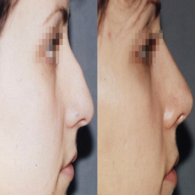 Resultados de rinoplastia antes y después en la Academia Ucraniana de Cirugía Plástica