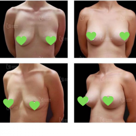 Mammoplasty Before & After Photos in Estetik International