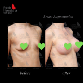 Mammoplasty Before & After Photos in Estetik International