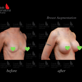 Mammoplasty Before & After Photos in Estetik International