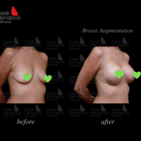 Mammoplasty Before & After Photos in Estetik International