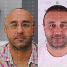 نتائج زراعة الشعر قبل وبعد في ClinicHair مع استعادة خط الشعر لدى مريض ذكر