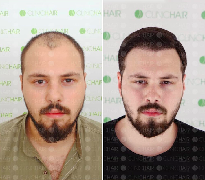 Resultado de trasplante capilar antes y después en ClinicHair, línea capilar restaurada