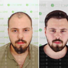 نتيجة زراعة الشعر قبل وبعد في عيادة ClinicHair، استعادة خط الشعر وكثافة أكبر