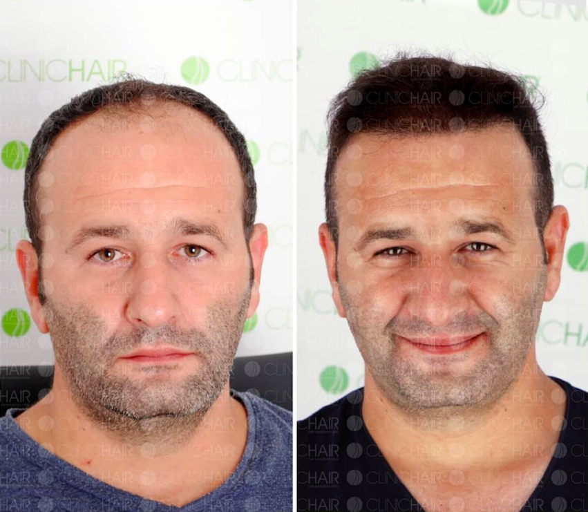 نتائج زراعة الشعر قبل وبعد في ClinicHair – استعادة خط الشعر وكثافة الشعر
