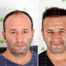 نتائج زراعة الشعر قبل وبعد في ClinicHair – استعادة خط الشعر وكثافة الشعر