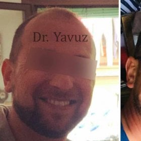 Resultados de trasplante capilar antes y después en Dr. Ziya Yavuz, línea de cabello más densa