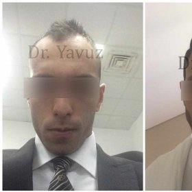 Resultados de trasplante capilar antes y después en Dr. Ziya Yavuz, línea capilar más densa