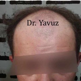 Resultados de trasplante capilar antes y después en Dr. Ziya Yavuz Hair Transplant Clinic