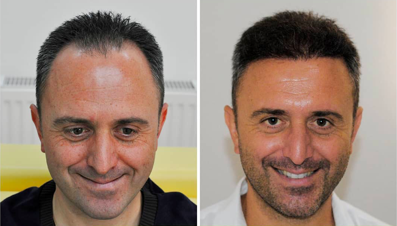 Resultados de trasplante capilar FUE antes y después en ClinicHair, mayor densidad en hombre