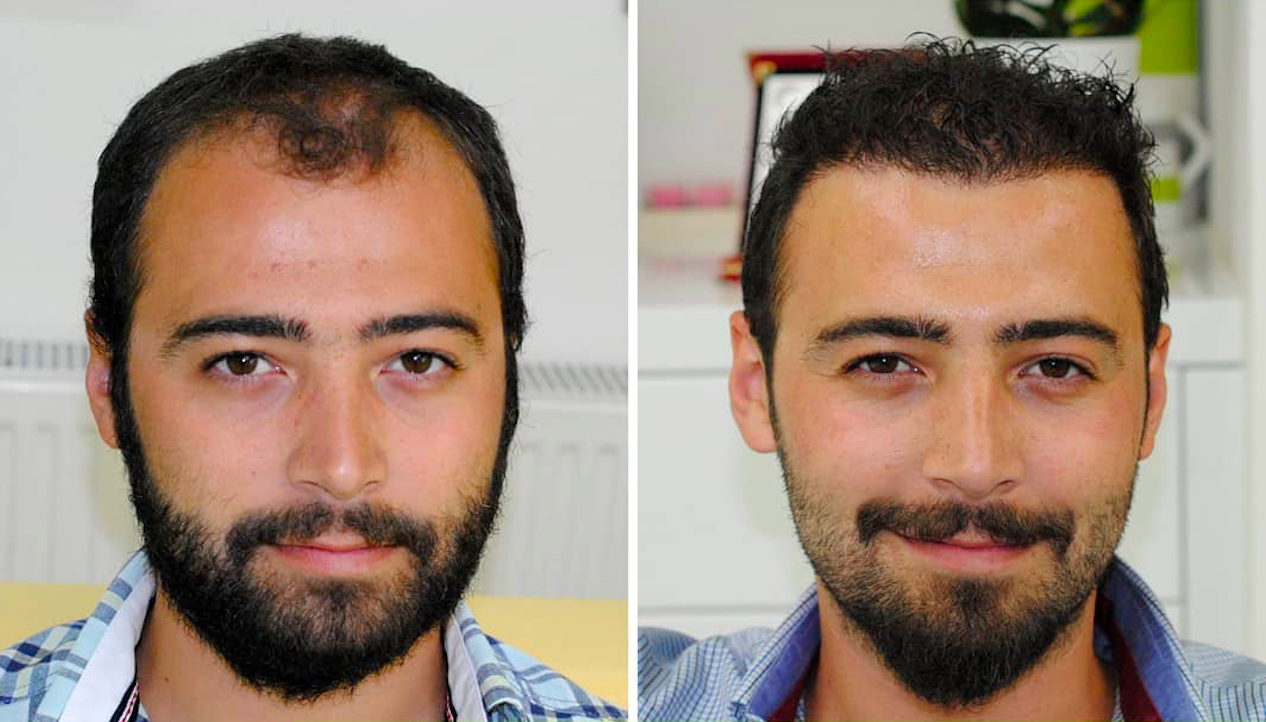 نتائج زراعة الشعر FUE قبل وبعد في ClinicHair – استعادة خط الشعر لدى المريض