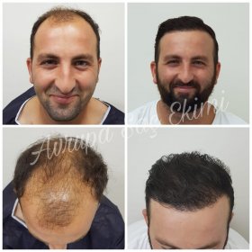 Resultados de trasplante capilar antes y después en Avrupa Sac Ekimi Clinic, línea restaurada