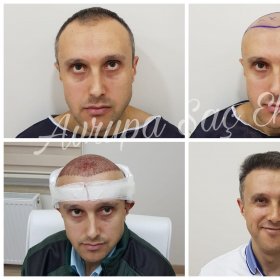 نتائج زراعة الشعر قبل وبعد في عيادة Avrupa Sac Ekimi، استعادة خط الشعر الطبيعي