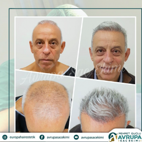 Resultados de trasplante capilar antes y después en Avrupa Sac Ekimi Clinic, línea restaurada