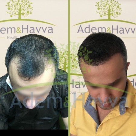 Resultados antes y después de trasplante capilar FUE en Adem and Havva Medical Center, línea de cabello más densa