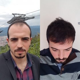 قبل وبعد زراعة الشعر في Suzermed Clinic – خط شعر مستعاد وكثافة شعر أكبر