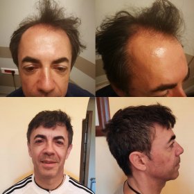 Resultados de trasplante capilar antes y después en Suzermed Clinic – línea capilar restaurada