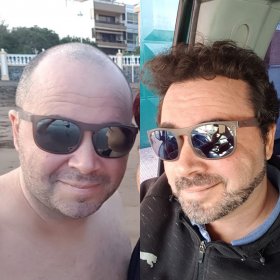 Antes y después de trasplante capilar en Suzermed Clinic – línea capilar restaurada y más densidad