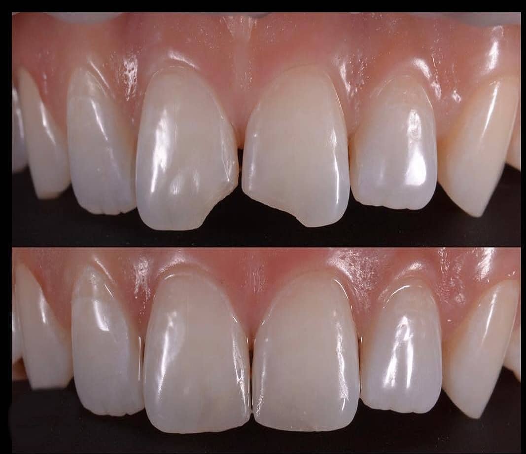 Resultados antes y después de restauración dental (bonding) en Dentisland Oral and Dental Center