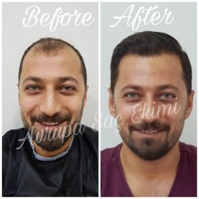 Resultados de trasplante capilar antes y después en Avrupa Sac Ekimi Clinic, línea restaurada