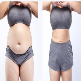 Tummy tuck Before & After Photos in View Plastic Surgery Hospital