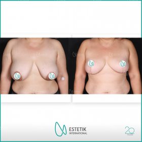Breast lift Before & After Photos in Estetik International